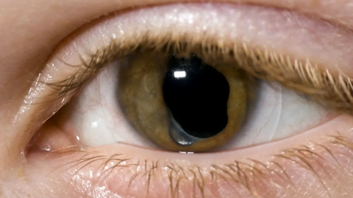 Operația care te scapă de orbire în 5 minute există și nu e doar un proiect