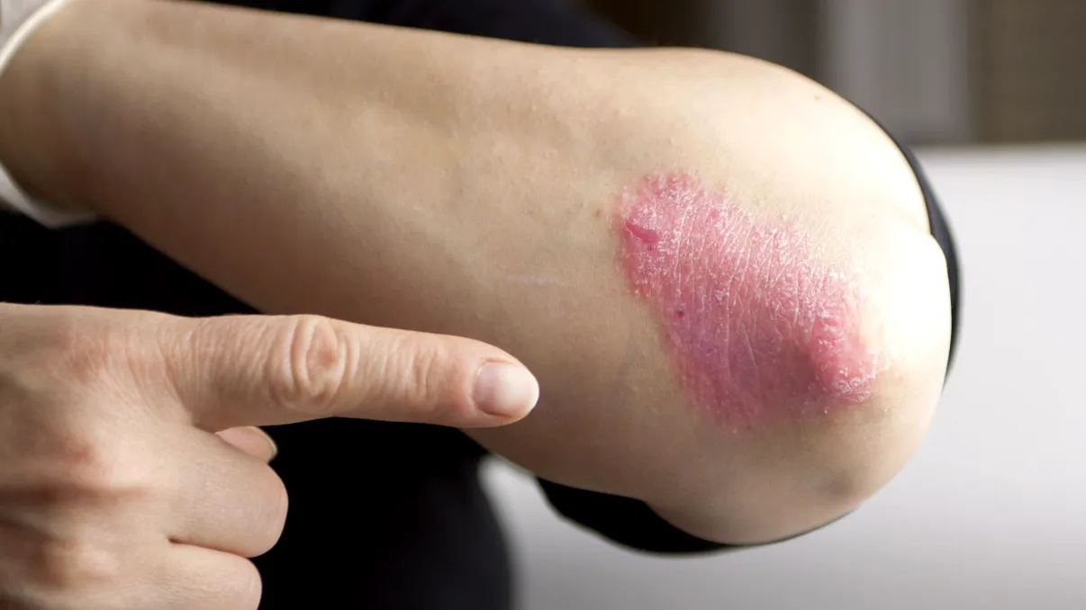 Oamenii cu psoriazis au un risc mai mare de să facă această boală