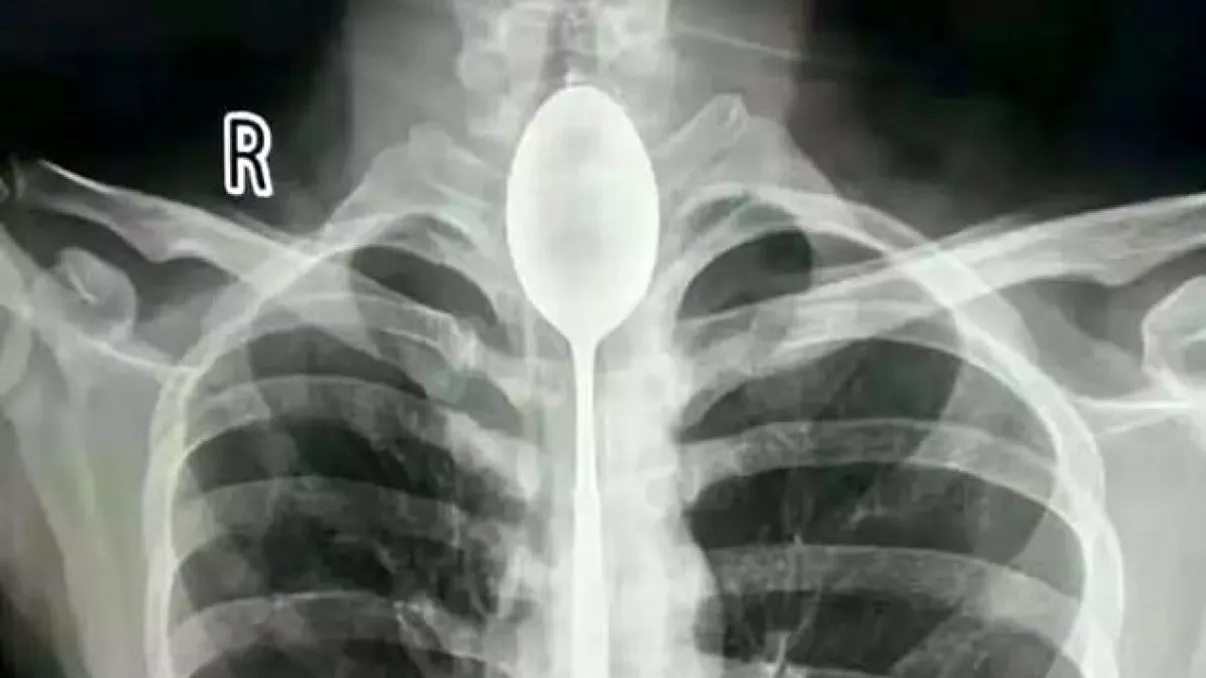 Cum a supraviețuit un bărbat cu o lingură în esofag timp de un an