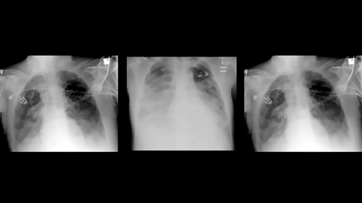 VIDEO Ce se întâmplă cu plămânii tăi, dacă ești infectat cu coronavirus