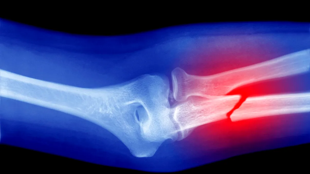 Premieră în știință: cercetătorii au reușit să crească la loc oasele rupte