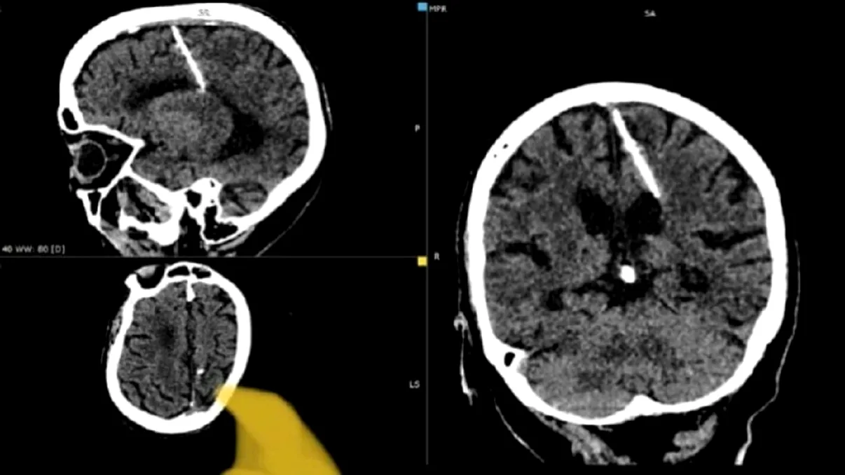 Trăiește cu un ac în creier de 80 de ani. Cum a fost posibil, explicațiile cercetătorilor