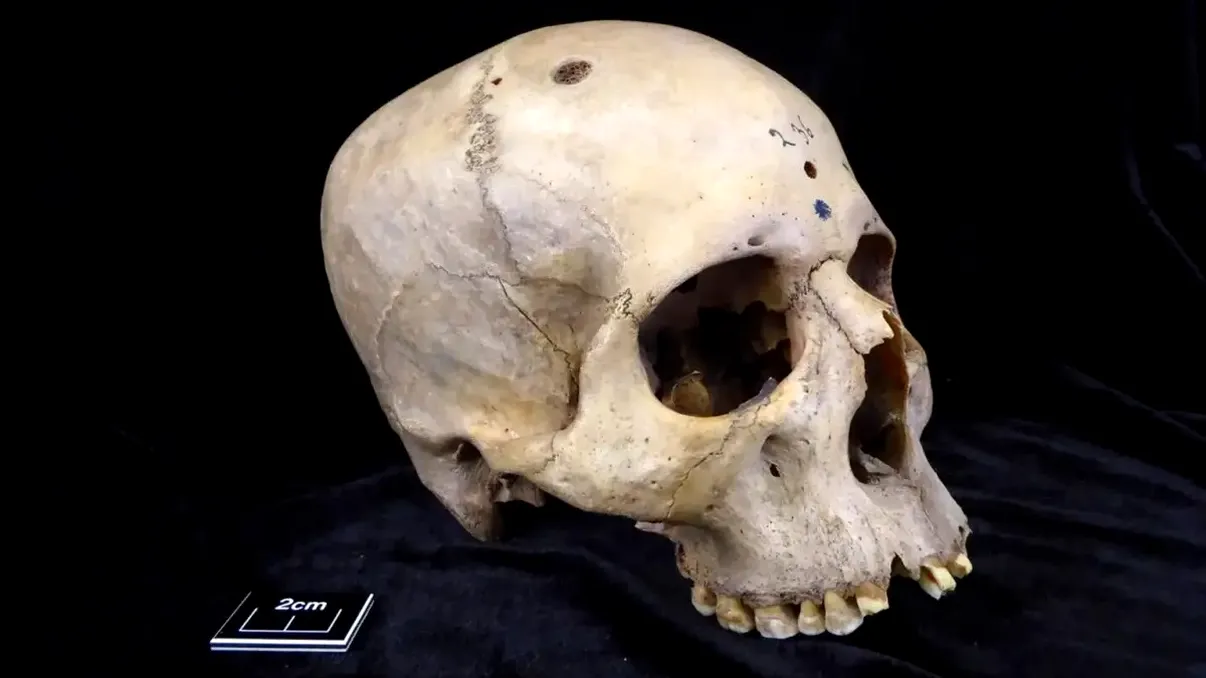 Tratamentele cancerului în Egiptul Antic dezvăluite de cranii vechi de 4.000 de ani