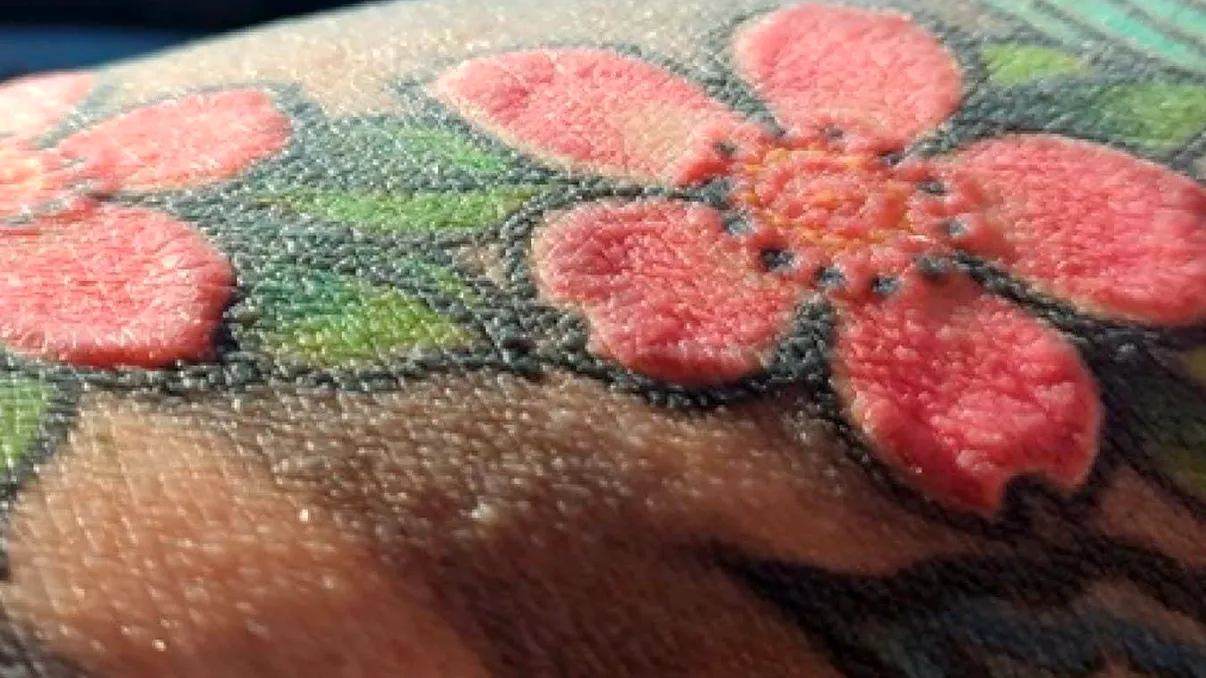 Reacții imune severe declanșate de tatuajele cu cerneală roșie: Cazul extrem al unui bărbat