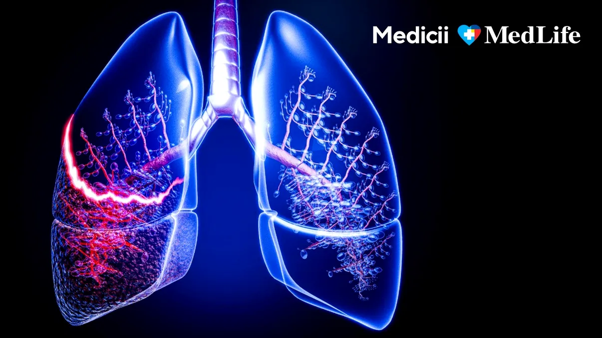 Medic pneumolog: „Nu ignora o tuse care durează mai mult de două luni”. Când simptomele respiratorii ascund afecțiuni serioase
