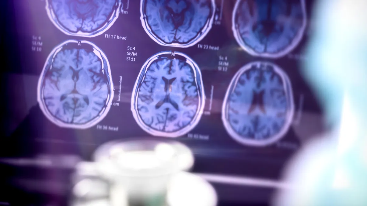 Gena care pare să protejeze creierul de Alzheimer îi pune pe cercetători pe o pistă nouă și neașteptată