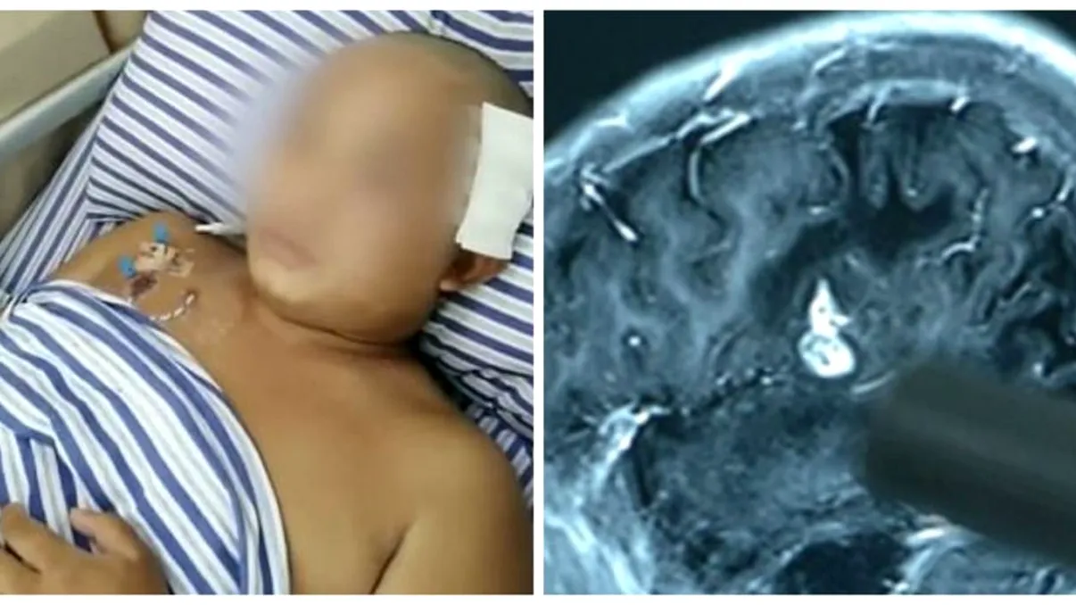 Îi amorțeau picioarele și s-a dus să își facă RMN. Ce au găsit medicii în creierul lui. Era acolo de 17 ani!
