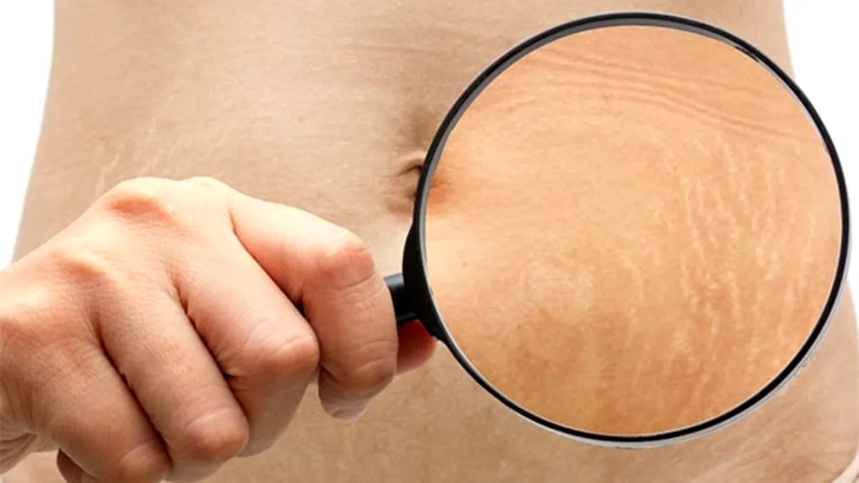 Cum scapi de vergeturi cu bicarbonat. Obții rapid și ușor rezultate vizibile