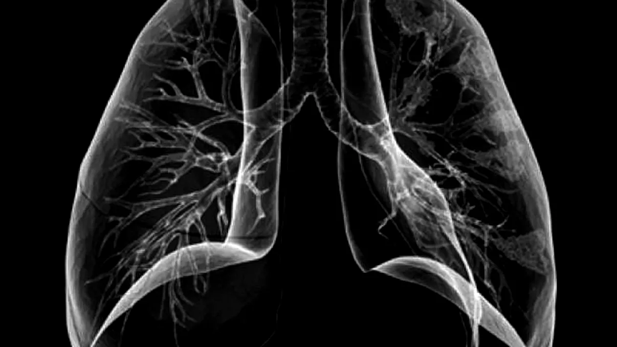 Testul care îți arată cât de sănătoși sunt plămânii tăi. Ce e spirometria