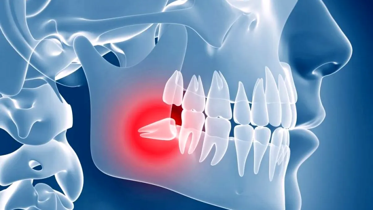 De ce ne scoatem măselele de minte, de fapt. Ce probleme grave pot cauza