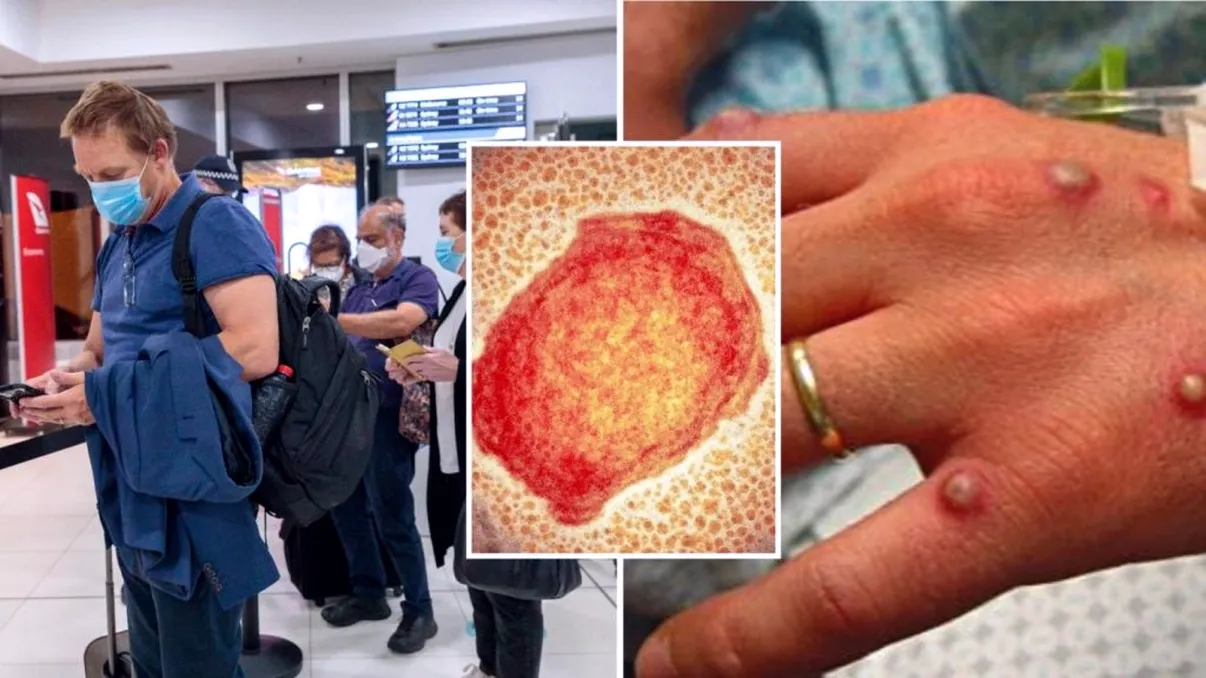 Obiectul de pe care poți lua variola maimuței. Dr. Marius Geantă trage un semnal de alarmă