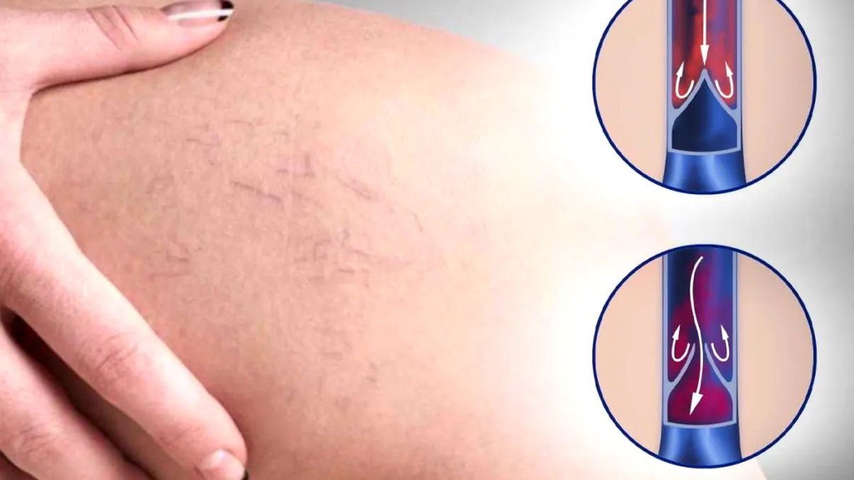 Cele 2 greșeli majore care duc la apariția varicelor. Ai grijă de tine și nu le mai face