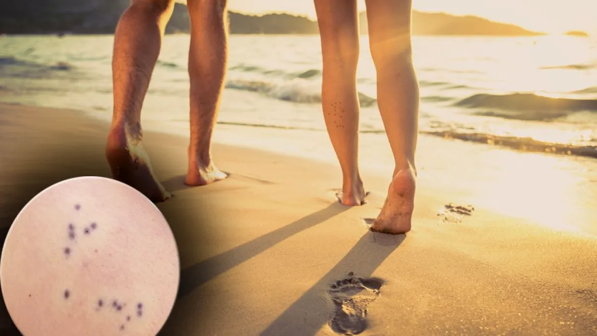 Noul pericol din adâncul mării. Ce trebuie să faci imediat dacă observi pe piele aceste puncte negre