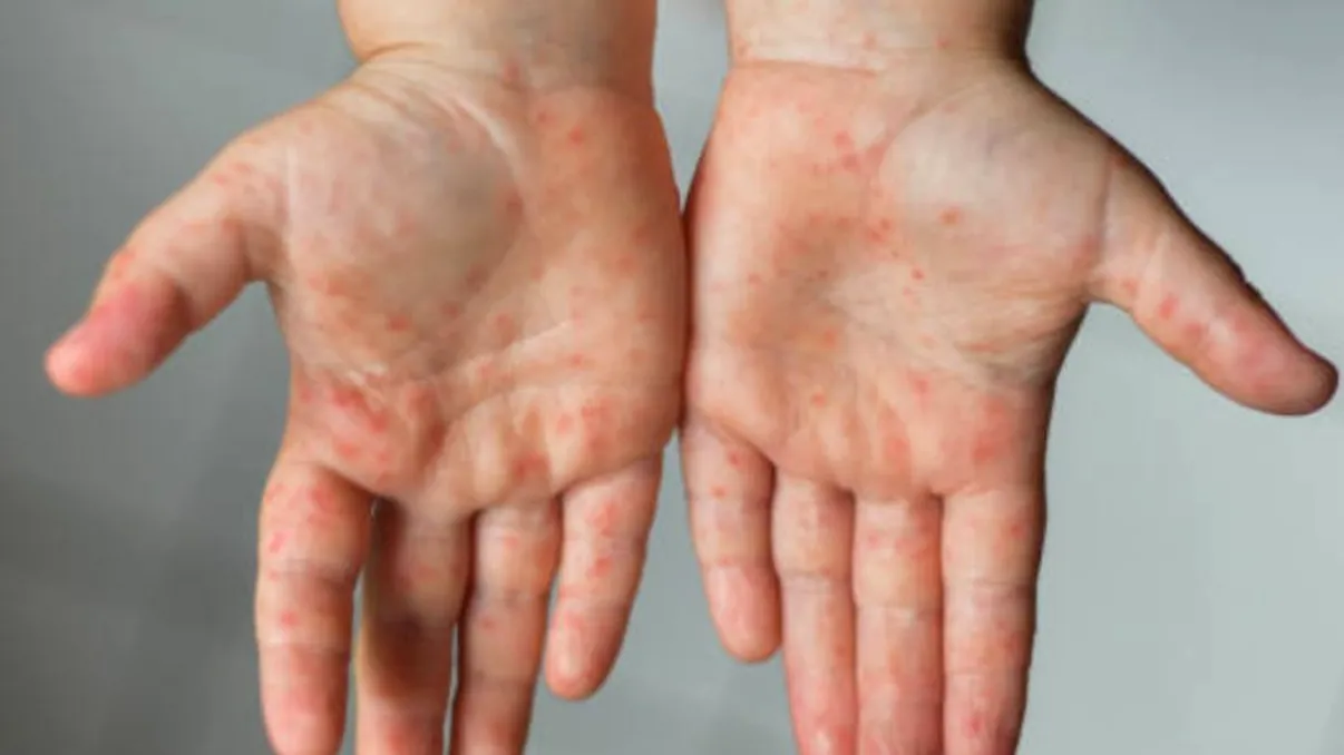 O nouă boală contagioasă se răspândeşte printre copii. Ce este „febra tomatelor” şi cum se manifestă