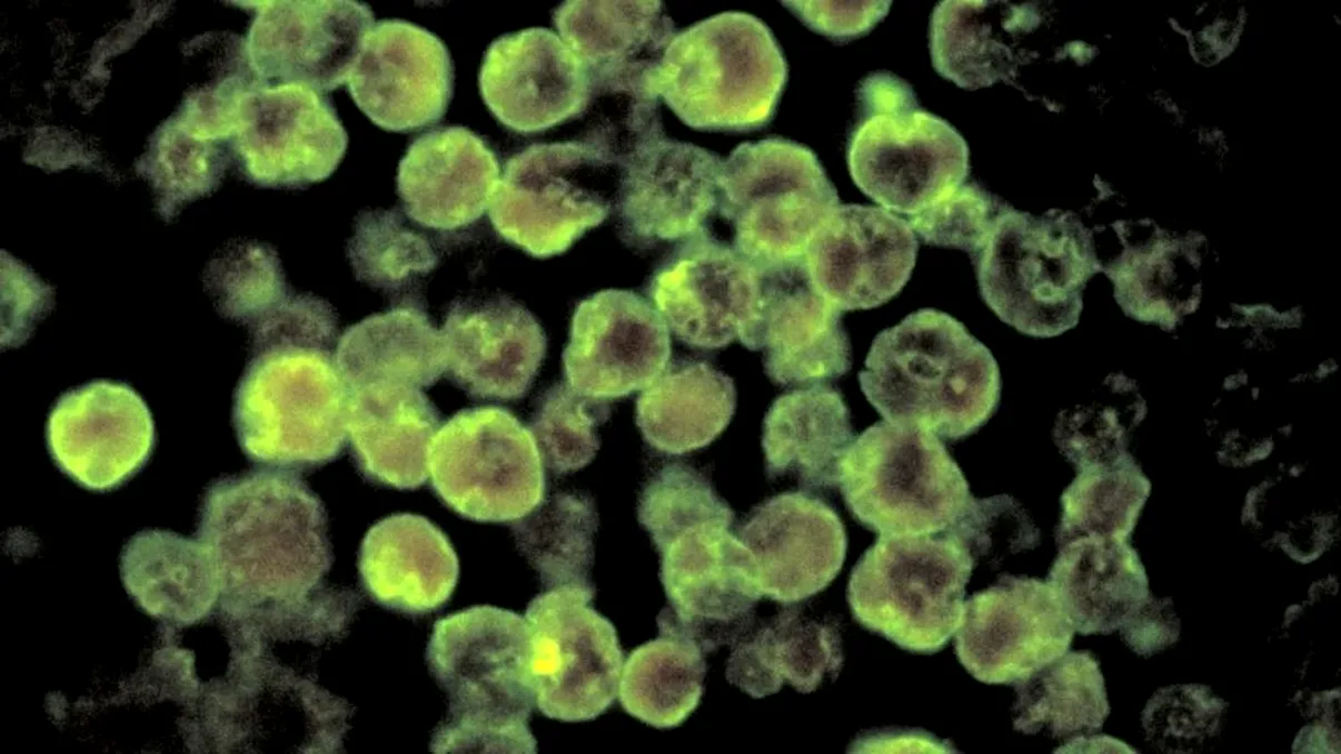 Un copil s-a infectat cu o amibă periculoasă, după ce a fost la plajă. Medicii, uimiţi de ce au găsit în creierul lui