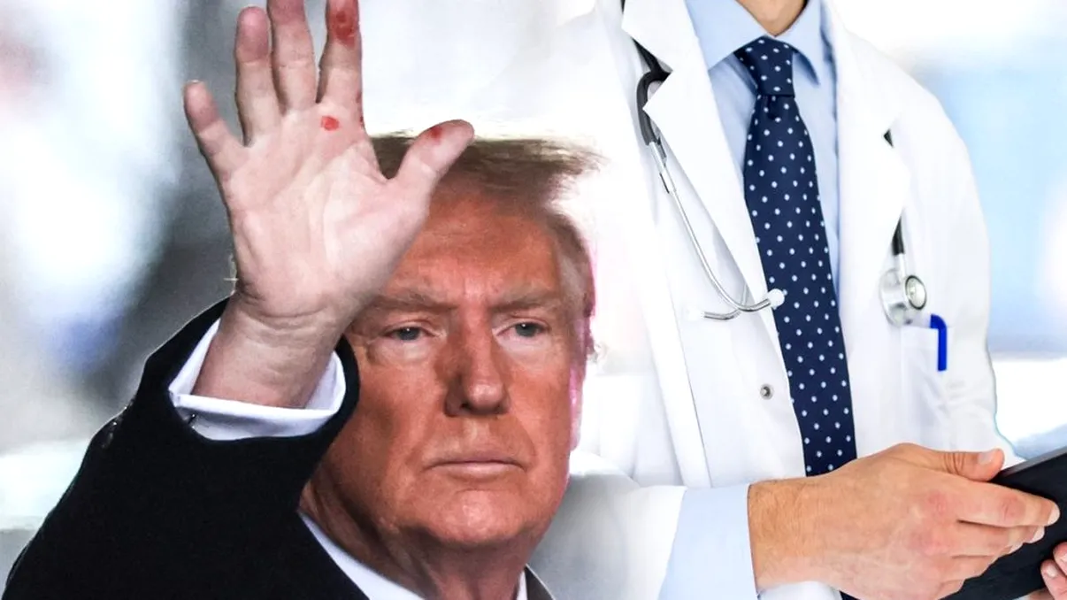 De la ce a făcut Donald Trump rănile de pe mâini, de fapt. Medicii au dat răspunsul clar