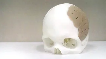 75% din craniul unui pacient a fost imprimat 3D