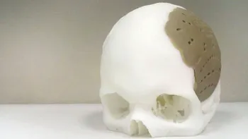 Un implant 3D de craniu? Sigur, cu succes! [+VIDEO]
