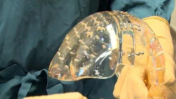 Un pas mare pentru medicină: primul transplant de cutie craniană printată 3D