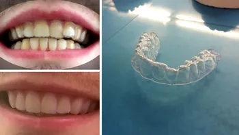Acest student și-a creat propria gutieră cu o imprimantă 3D