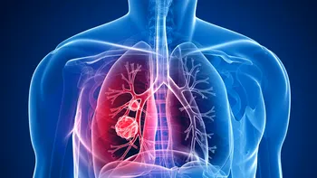 Cancerul pulmonar poate fi prevăzut de căutările pe care le faci pe Internet