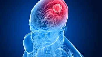Pielea umană, posibil remediu pentru cancerul cerebral