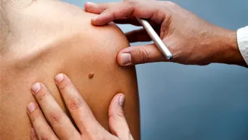 Sistemul care poate detecta cancerul de piele mai bine decât medicii