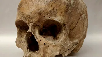 Originea uneia dintre cele mai vechi și stigmatizate boli din istorie