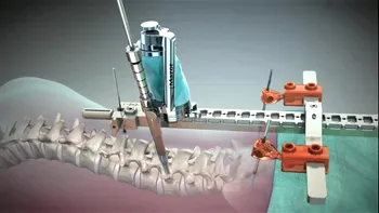 Robotul care a îndepărtat o tumoră din coloana vertebrală este o premieră