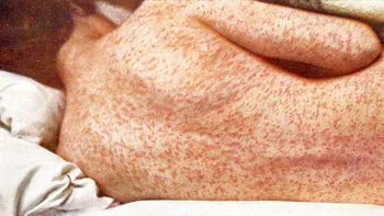 Singura soluție ca anti-vacciniști să nu mai condamne la moarte copiii
