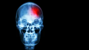 Accidentele vasculare cerebrale: de ce apar și cum se tratează?