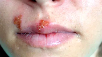 Virusul herpes devine mai periculos ca oricând, potrivit specialiștilor