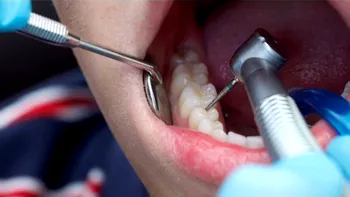 De ce plombele dentare s-ar putea să nu fie atât de necesare pe cât se credea