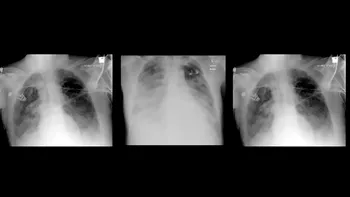 Adevăratele consecințe pe termen lung ale infecției cu coronavirus: ce se întâmplă cu plămânii
