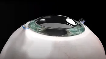 Gadgetul care i-a redat vederea: un implant de cornee sintetică a făcut minuni în cazul unui orb