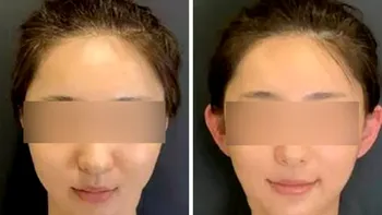 Cel mai ciudat trend estetic vine din China: de ce se caută urechile de elf