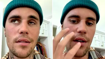 Ce este sindromul Ramsay Hunt, de care suferă Justin Bieber: simptome și metode de vindecare