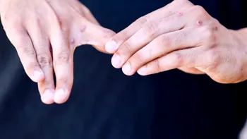 Țara care a confirmat primul deces cauzat de variola maimuței. Epidemia a devenit urgență sanitară globală