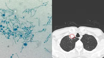 Caz unic în lume. Un bărbat a fost diagnosticat cu Chondrostereum purpureum. „Deschide Cutia Pandorei pentru noi boli”