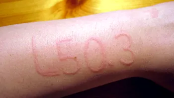 Ce este dermatografia, condiția medicală extrem de rară care afectează 3% din populația globului