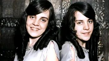 Povestea tragică a siamezei care a trăit lipită de trupul decedat al surorii sale. Ororile la care au fost supuse fetele pe timpul vieții VIDEO