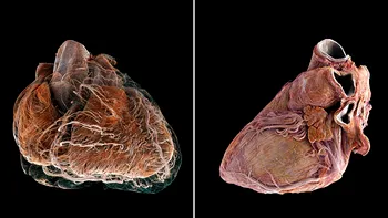 Un VIDEO uimitor arată diferența dintre o inimă sănătoasă și una afectată de boli cardiovasculare