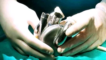 Inovație în medicină: Primul implant de inimă din titan. Cum funcționează, conform cercetătorilor