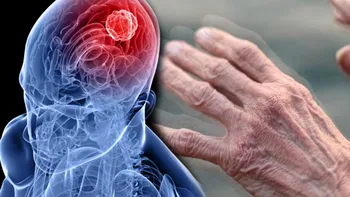 De ce bărbații se îmbolnăvesc de Parkinson mai ușor decât femeile. Explicația științifică pentru riscul dublu