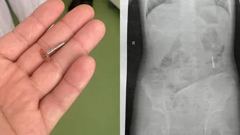 Un dentist din Iași a scăpat în gura unui copil de 5 ani o freză metalică, apoi le-a spus părinților că a înghițit o bucată de hârtie. Ce au aflat când au mers la spital