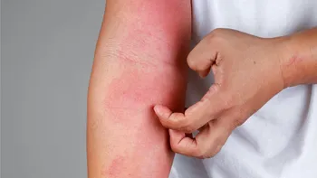 Alergia care te face intolerant la carne și lactate se răspândește rapid la nivel global. Ce au aflat oamenii de știință