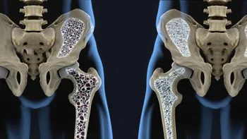 Descoperirea care ar putea „pune cruce” osteoporozei. Cum scapi de una dintre cele mai comune boli ale oaselor, conform unui studiu