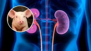 Transplantul de organe de porc la om a mai trecut un prag important. Timpul de supraviețuire al pacienților a crescut considerabil