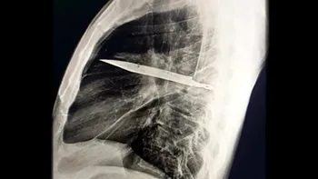 Un bărbat a trăit cu un cuțit în torace timp de 8 ani fără să știe. Dilema medicală care i-a uimit pe oamenii de știință