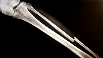 Adezivul pentru oase care le lipește în câteva minute este revoluția în medicină